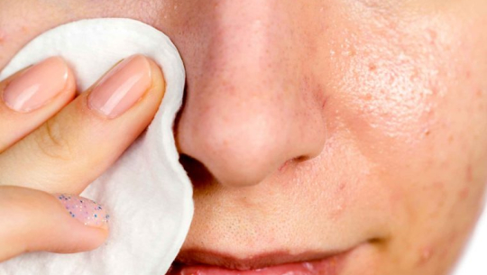 Homemade remedies to remove blackheads