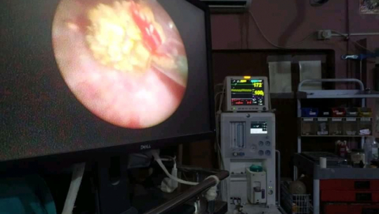 Kailali Hospital successfully operates a 7.8 mm stone stuck in the urethra of a toddler