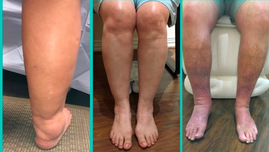 कञ्चनपुरका गाउँ–गाउँमा हात्तीपाइले र हाइड्रोशिलका बिरामीको खोजी