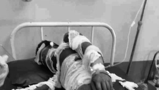 अछाममा आफ्नै शरिरमा आगो लगाएर घाइते भएका आउजीको मत्यु