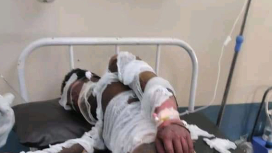 अछाममा अस्पतालबाट हटाइएका कर्मचारीले आफ्नै शरीरमा आगो लगाए