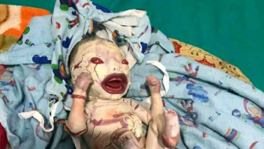 Physically different child born in Kanchanpur