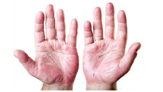 सुदूरपश्चिम प्रदेशमा कुष्ठरोग निवारण हुन सकेन्