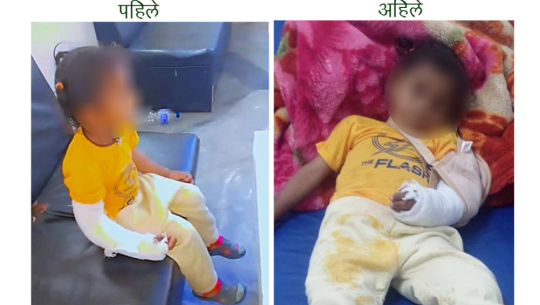 बझाङमा देब्रे हात भाँच्चिएका बालकको दाहिनेमा प्लास्टर