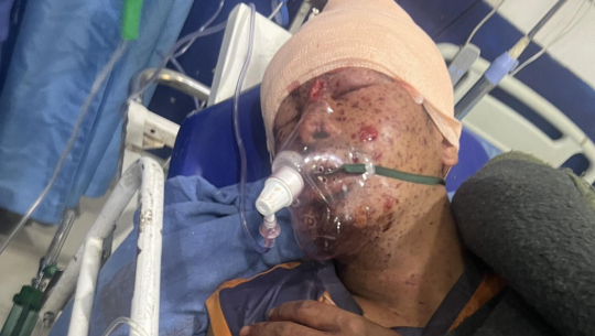 भाँसु भिरमा द्धन्दकालमा राखेको एम्बुस विस्फोट हुदा चार जना घाईते
