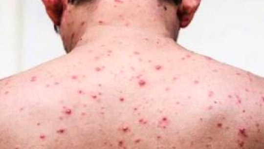 बैतडीको सुर्नयामा ठेउला सङ्क्रमण पुष्टि