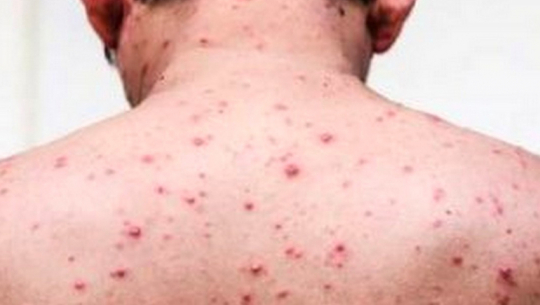 Smallpox infection confirmed in Baitadi’s Surnaya rural municipality