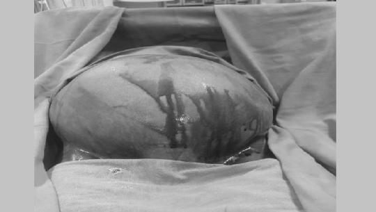 धनगढीको निसर्गमा निकालियो महिलाको पेटबाट ७ किलोको मासुको डल्लो