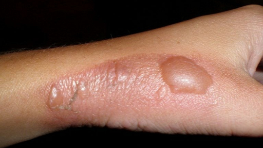 डोटीमा आगोले जली तीन वर्षीया बालिका घाइते