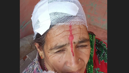 बैतडीमा बाँदरको आक्रमणबाट एक महिला घाइते