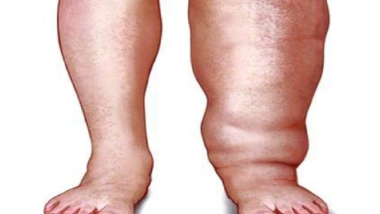 कैलालीसहित देशभरका १२ जिल्लामा हात्तीपाइले रोग अझै निवारण हुन सकेन