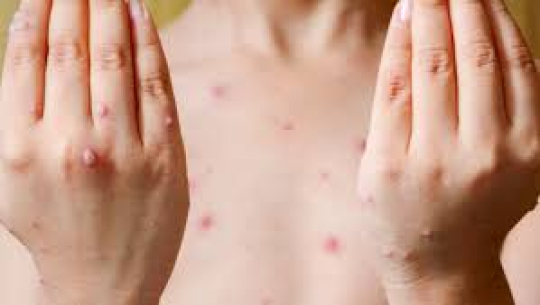 फोटोः हेल्थ टुडे नेापल