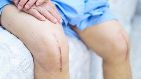 ८६ वर्षीया वृद्धाको पहिलो पटक जोर्नी प्रत्यारोपण