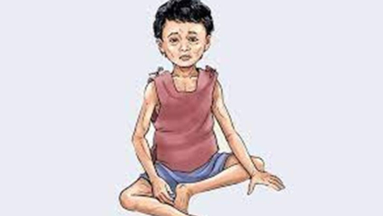 नेपालमा ३२ प्रतिशत बालबालिका दीर्घरुपमा कुपोषित