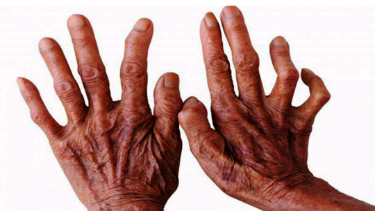 सुदूरपश्चिममा कुष्ठरोगको समस्या यथावत