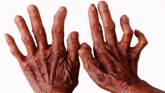 Leprosy remains a challenge in Far-west Nepal despite national eradication