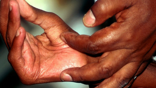 डोटीमा थपिए कुष्ठरोगी