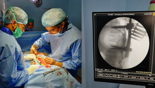 Maya Metro hospital conducts yet another successful spinal cord surgery