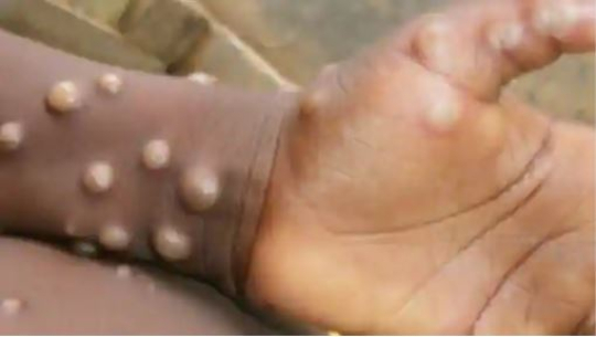 चीनमा ‘मंकी बी भाइरस’, एक डाक्टरको मृत्यु