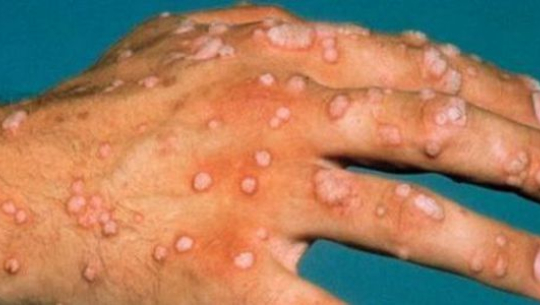 मुसा आएर चिन्तित हुनुहुन्छ? यसो गर्नुहोस्