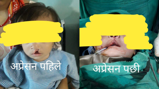 सुदूरपश्चिममा खुडे ओठको उपचार निसर्ग हस्पिटलमा