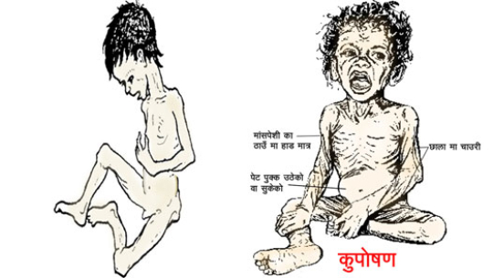 बाजुरामा ४८ प्रतिशत बालबालिकामा कुपोषण, ५ बालबालिकाको मृत्यु