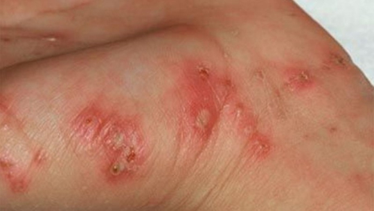 सुदुरपश्चिममा स्क्रबटाईफसको प्रकोप वढ्दै