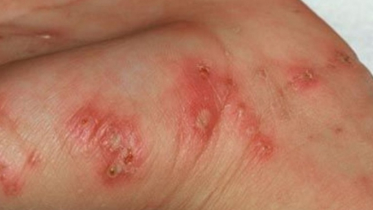 Scrub Typhus alarms Sudurpaschim