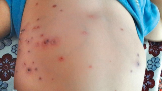 कोभिड–१९ जस्तै लक्षण भएको ‘स्क्रब टाइफस’ रोग