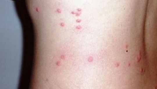 Five scrub typhus patients found in Darchula