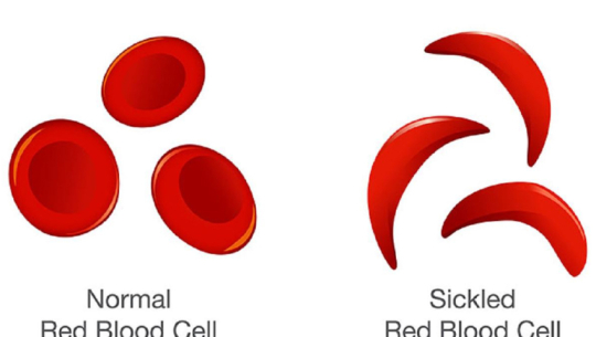 कञ्चनपुरको लालझाँडीमा दुई सय २३ जनामा ‘सिकलसेल एनिमिया’  