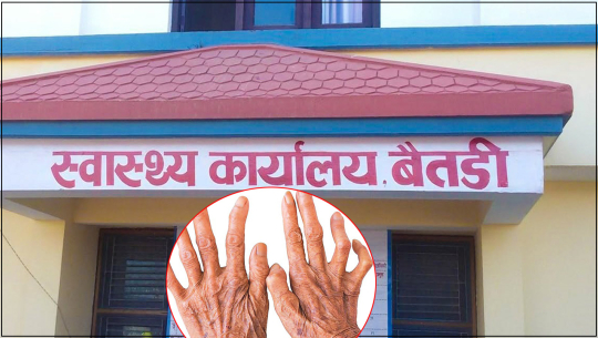 तीन वर्षको अवधिमा बैतडीका १६ जनामा कुष्ठरोग पुष्टि